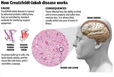 Creutzfeldt–Jakob disease .